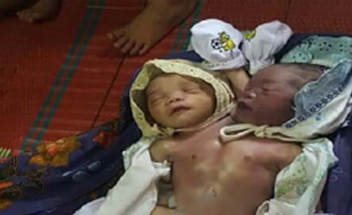 Bayi kembar siam yang lahir di Tapanuli Tengah, Sumatera Utara hari Rabu lalu. (foto: rri.sumut)