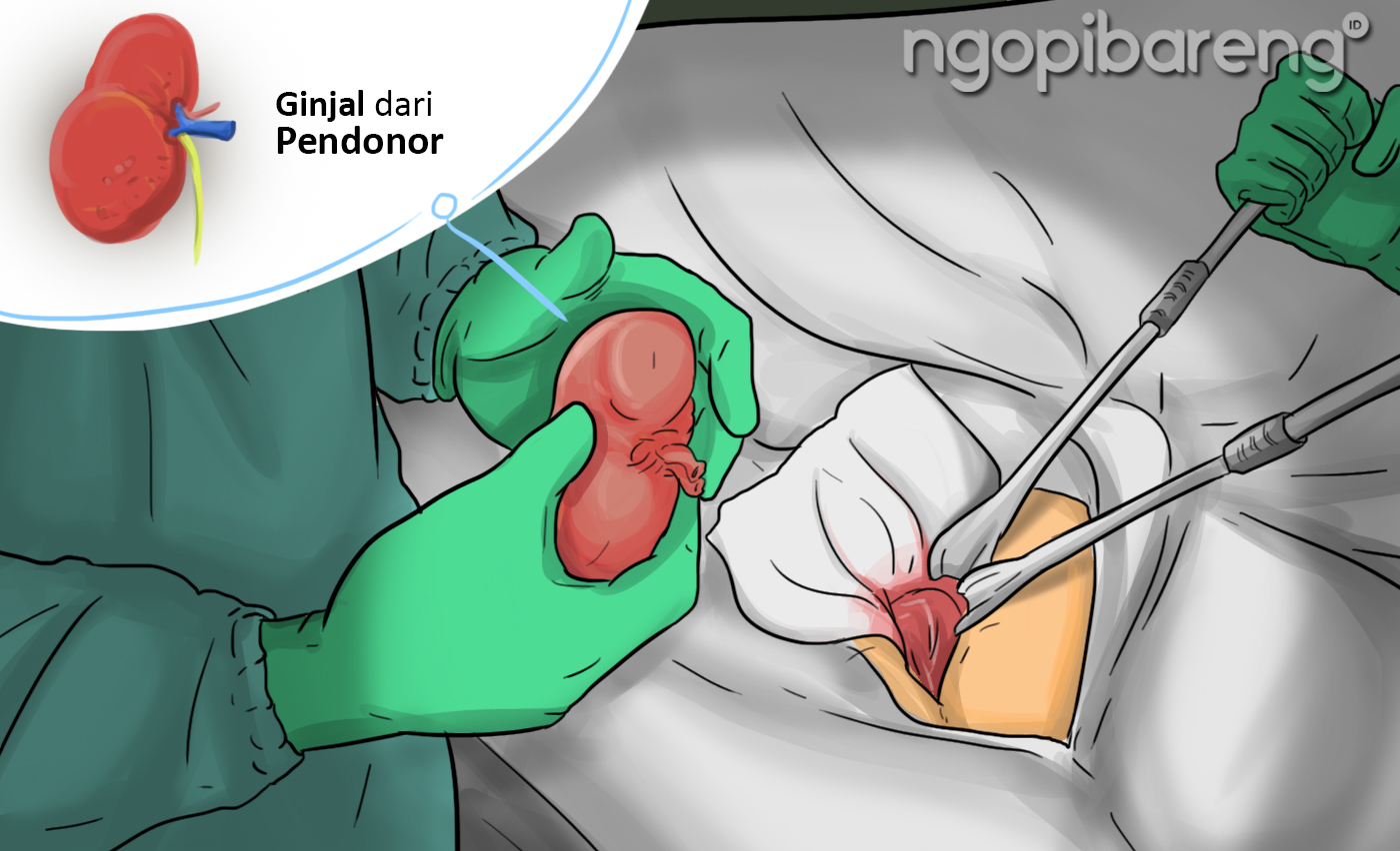 Ilustrasi transplantasi ginjal (Ilustrator: Faizalachh)