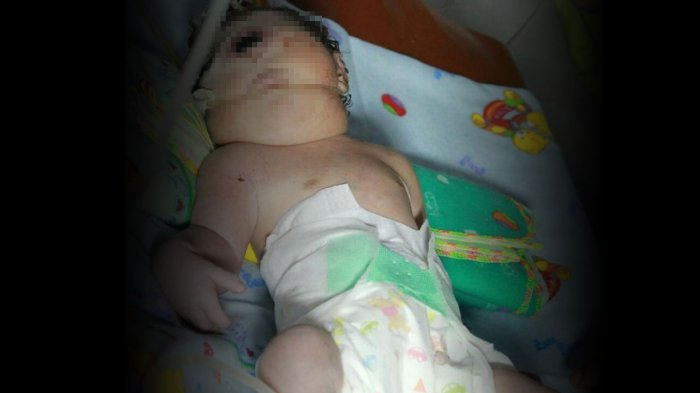 Bayi perempuan lahir dengan kondisi satu mata dan mulut, tanpa mempunyai hidung di Mandailing Natal, Sumatera Utara, Kamis 13 September 2018.