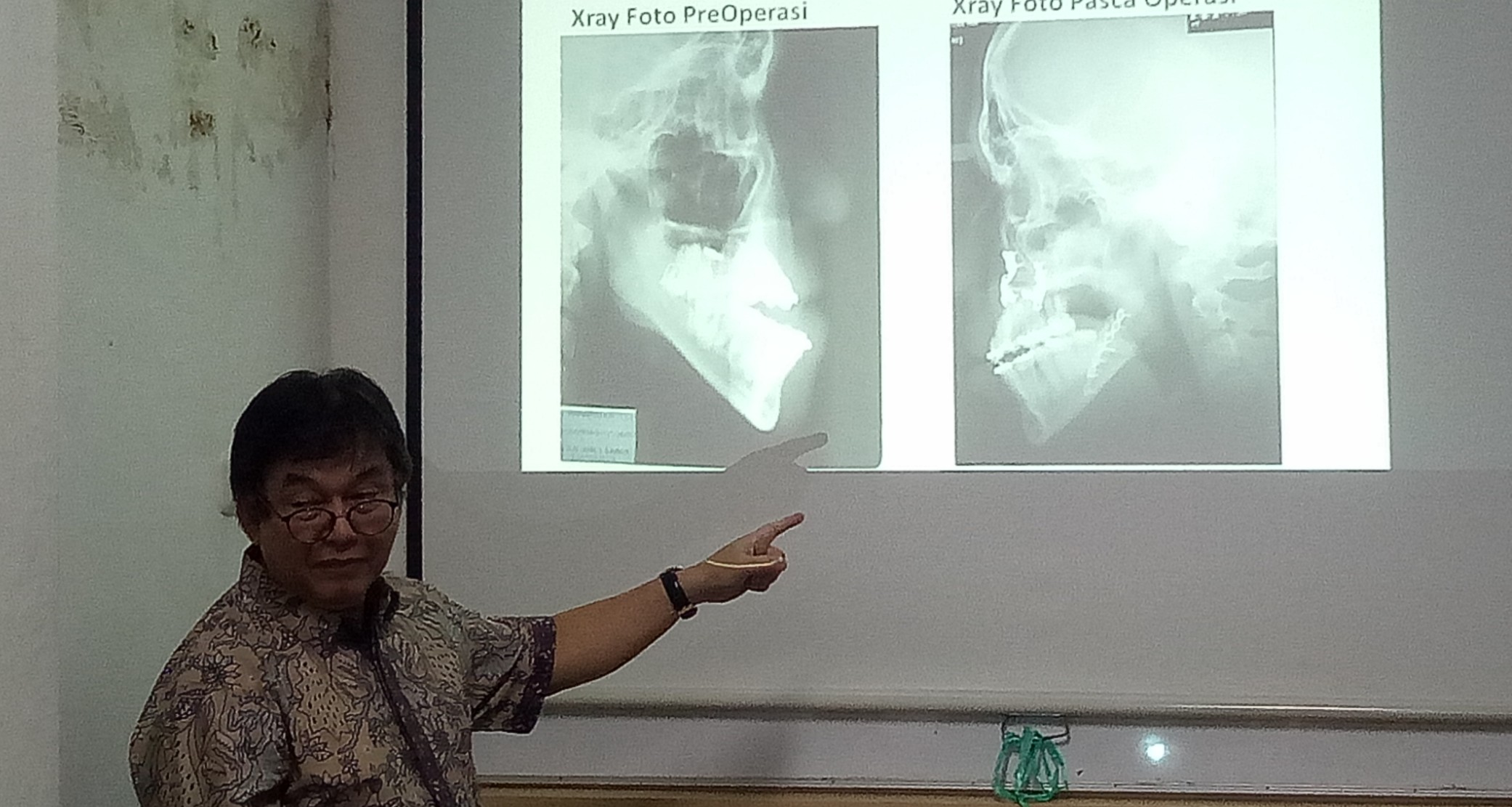 Prof. Coen Pramono,  menerangkan bedah ortognatik kepada wartawan, Jumat 11 Januari 2019. (Foto: Pita/ngopibareng.id)