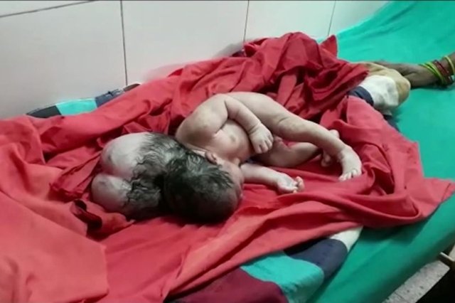 Kondisi bayi berkepala tiga yang lahir di India. (Foto: Mirror)