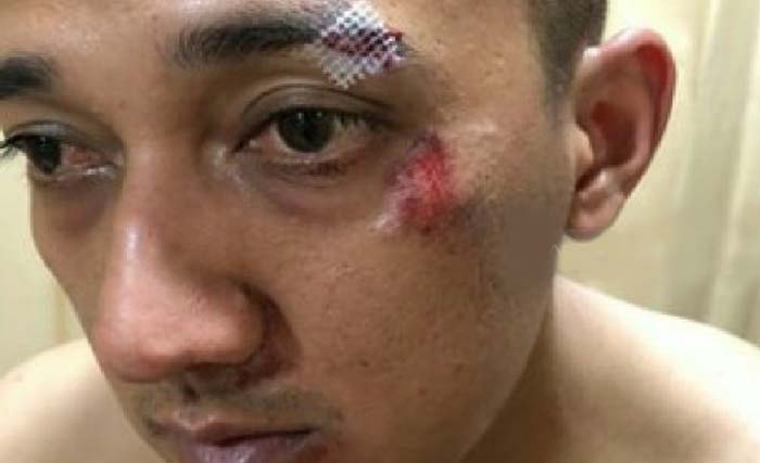 Wajah Kapolsek Patumbak AKP Ginanjar Fitriadi yang luka akibat dikeroyok geng narkoba di Medan. (Foto: Antara)