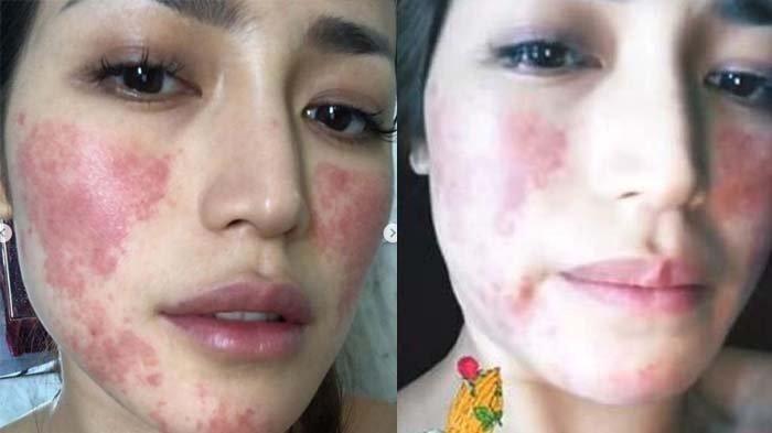 Ruam merah penuhi wajah Jessica Iskandar karena alergi anestesi. (Foto: Instagram @inijedar)