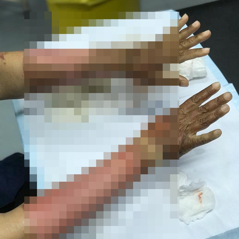 Tangan terbakar api usai pakai hand sanitizer viral di media sosial. (Foto: Istimewa)