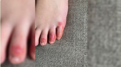 Jempol kaki merah dan gatal bisa jadi pertanda terinfeksi covid-19. (Ilustrasi)