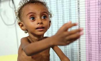 Ferial Elias, balita kekurangan gizi yang dirawat di rumah sakit di Kota Hodeidah, Yaman. (Foto:Reuters) 