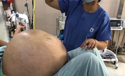 Tumor seberat 54 Kg. ini berhasil diangkat di  Rumah Sakit Indraprastha, Apollo, India. (Foto:NastionalHeralIndia)d.