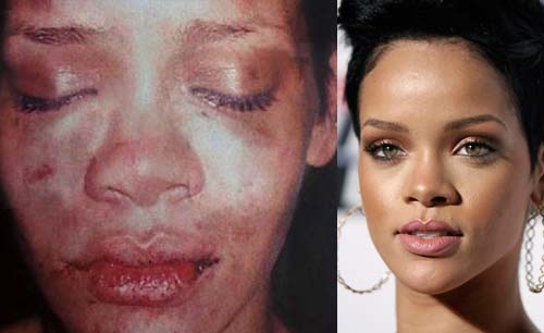 Wajah penyanyi Rihanna memar (kiri) usai kecelakaan skuter listrik.(Foto:TMZ)