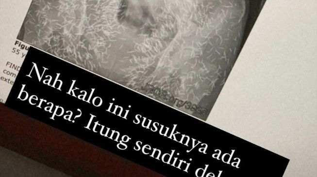 Sebuah foto X-Ray yang menangkap adanya susuk di tubuh seorang pasien. (Twitter/@AREAJULID)