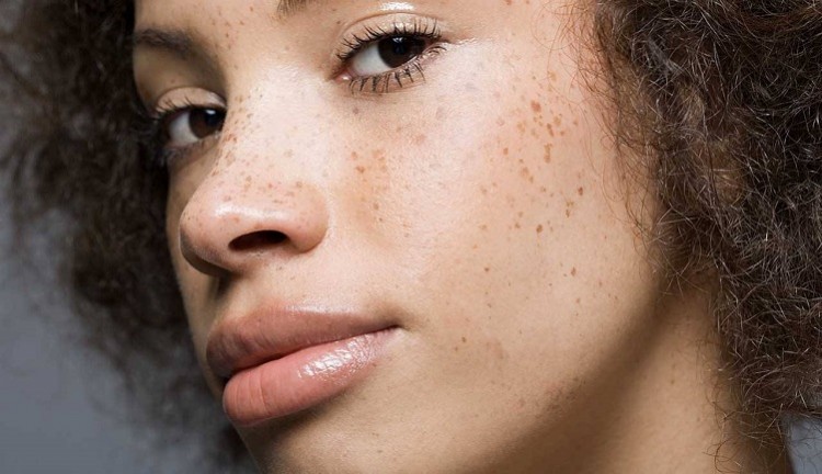 Ilustrasi freckles di wajah. (Foto: Google)