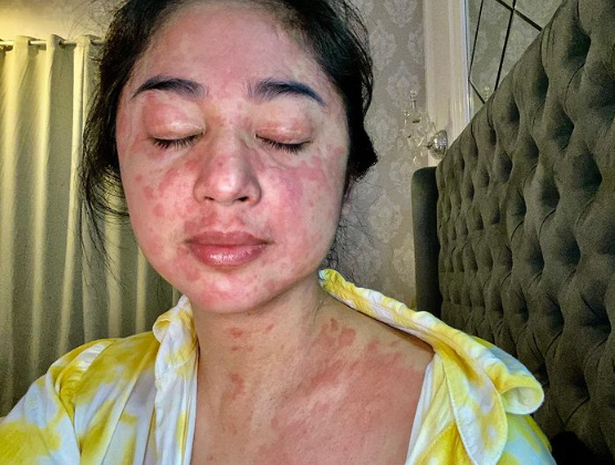 Pedangdut Dewi Perssik memperlihatkan ruam merah di wajah dan tubuhnya, gejala Covid-19 yang langka. (Foto: Instagram @dewiperssikreal)