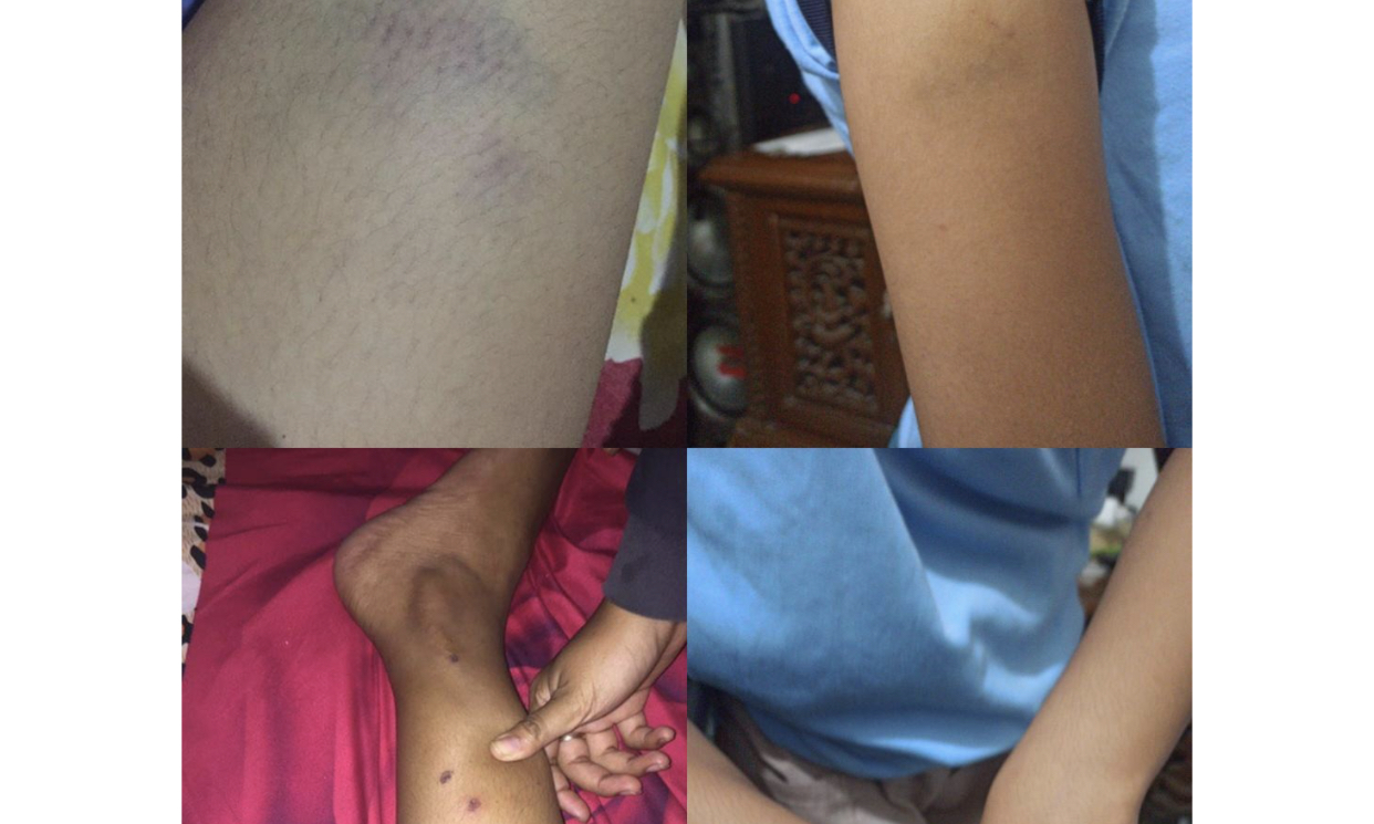 Foto bekas kekerasan yang diterima korban dari pacarnya (Foto: akun Twitter @juragansachetan)