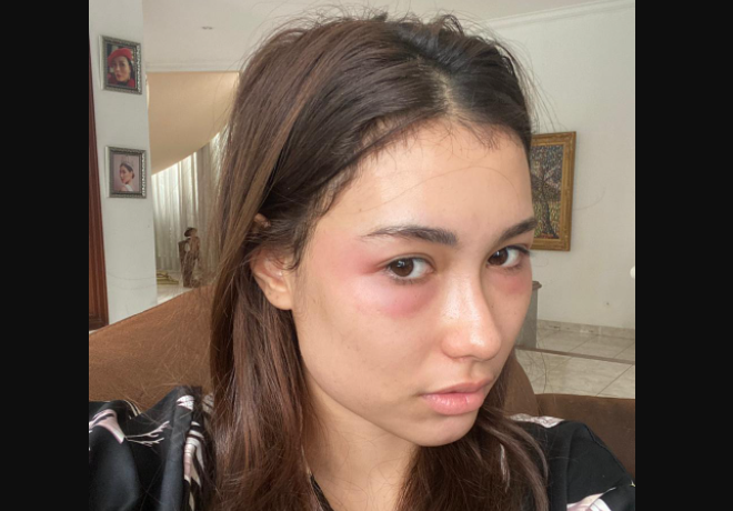 Frederika Alexis Cull, Puteri Indonesia 2019, memperlihatkan foto wajahnya lebam dan seperti terbakar usai perawatan kecantikan. (Foto: Dok. Pribadi)