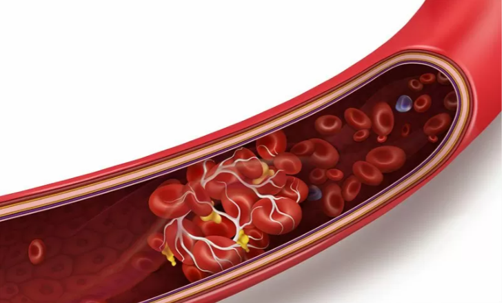 Ilustrasi pembekuan darah. (ilustrasi: Shutterstock)