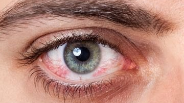 Ilustrasi mata merah karena benda asing masuk ke dalama mata. (Foto: Google)