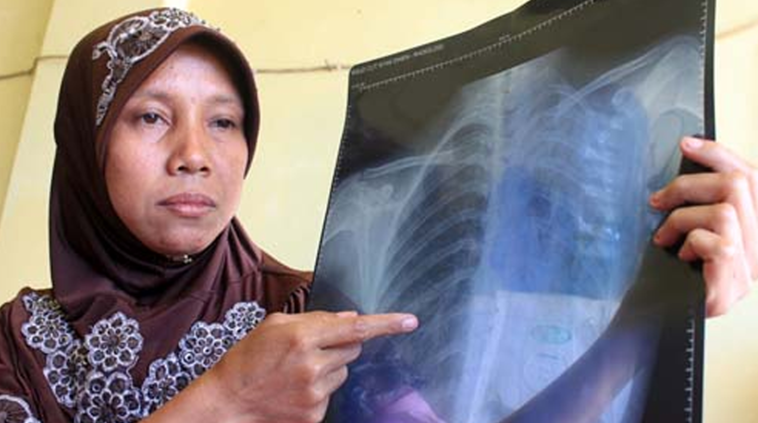 Seorang ibu di Kelurahan Kemuteran Gresik menunjukkan hasil rontgen paru-parunya yang menurut dokter ada flek hitam. (Foto:Istimewa)