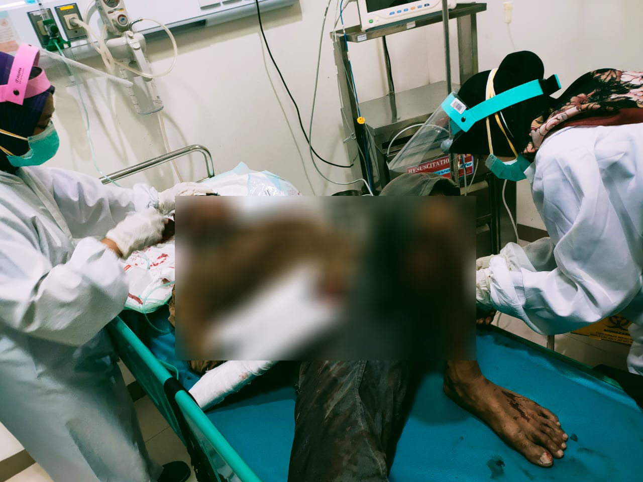 Korban ketika menjalani perawatan di RSKK Gumul Kediri. (Foto: Fendhy Plesmana/Ngopibareng.id)