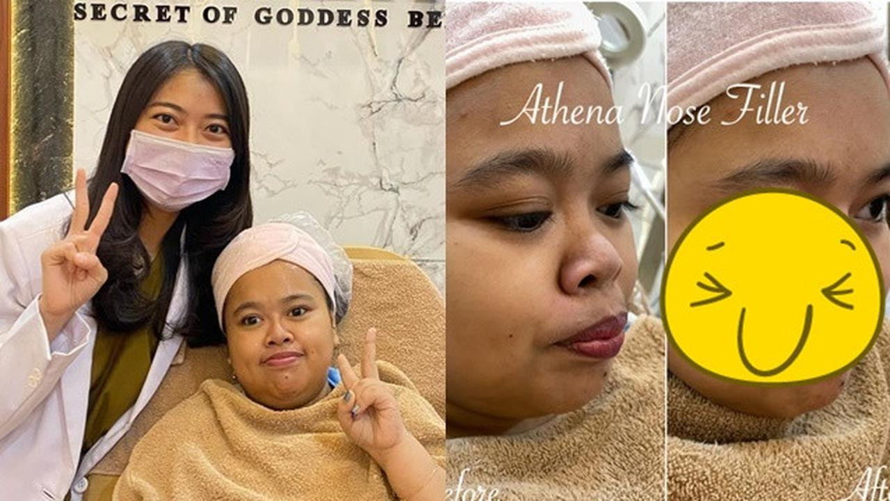 Selebgram Rahmawati Kekeyi Putri Cantika melakukan filler hidung. (Foto: Instagram)