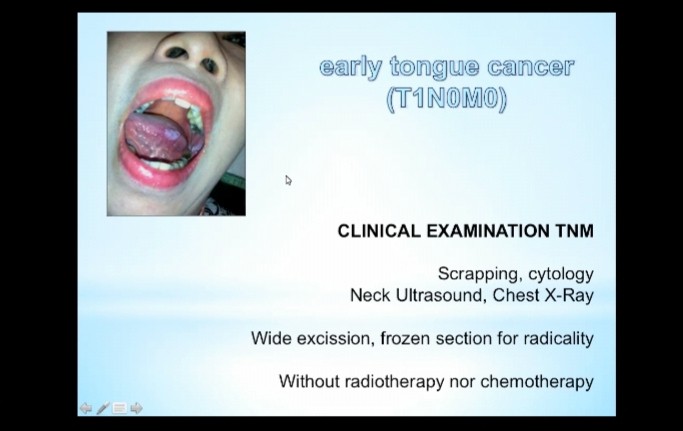 Materi dr Hari Susilo dalam webinar AHCC yang menerangkan salah satu gejala kanker kepala dan leher, yakni sariawan. (Foto: Tangkapan layar webinar AHCC)