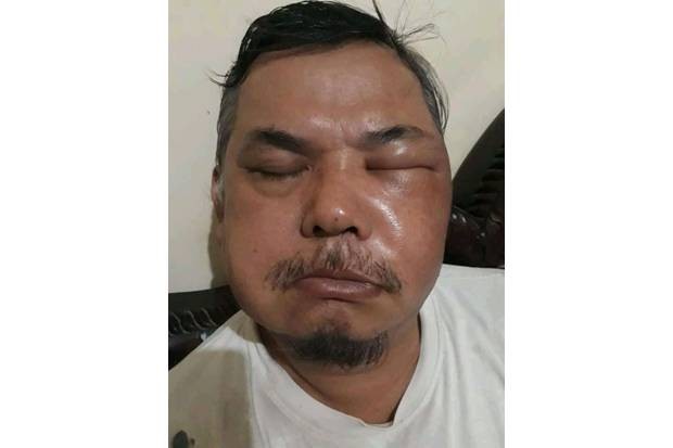 Agus Purjantoro, warga Pondok Aren, Tangerang Selatan (Tangsel) wajahnya mengalami bengkak-bengkak hingga mengeluarkan bau amis. (Foto: metro.sindonews.com/MNC Portal)