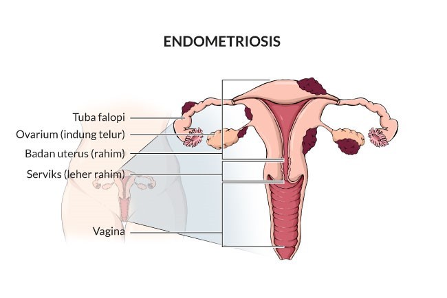 Infografis Endometriosis. (Grafis: Istimewa)