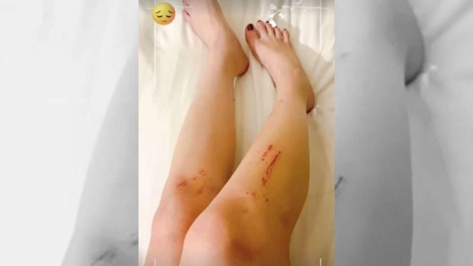Ayu Thalia pamer foto kaki luka diduga akibat jatuh usai didorong anak Ahok. Hal ini sesuai kronologi laporan Ayu Thalia ke polisi. (Foto: Instagram)