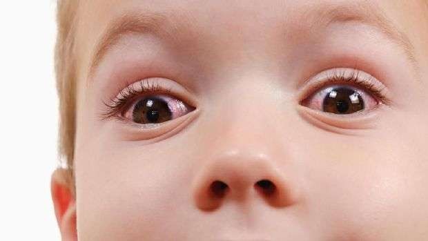 Ilustrasi mata merah pada anak. (Foto: Istimewa)