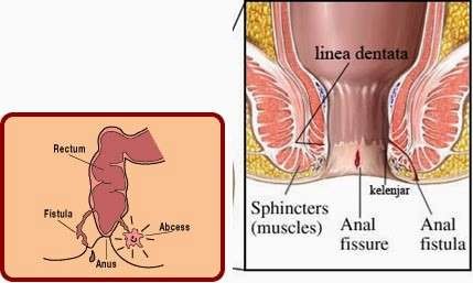 Ilustrasi bahaya seks anal pada organ anus. (Grafis: Istimewa)