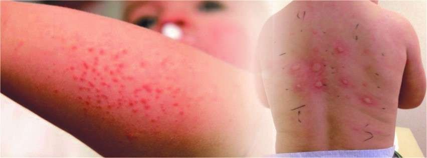 Ilustrasi alergi yang gejalanya berupa ruam atau bercak merah di kulit tubuh. (Foto: Istimewa)