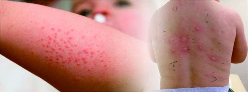 Waspadai alergi dingin pada tubuh ketika musim hujan. (Foto: Istimewa)