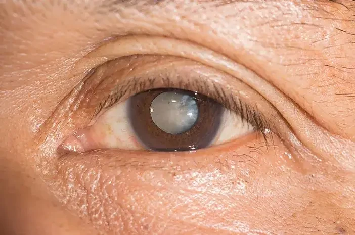 Ilustrasi penyakit mata glaukoma. (Foto: Istimewa)