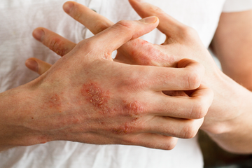 Ilustrasi waspada penyakit herpes bisa menimbulkan komplikasi penyakit. (Foto: Istimewa)