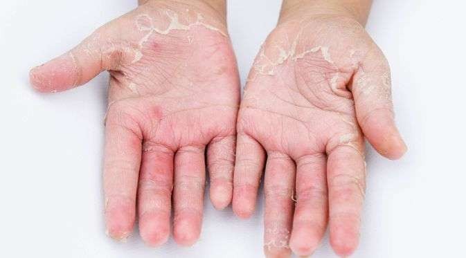 Ilustrasi tangan yang terkena Dermatitis. (Foto: istimewa)