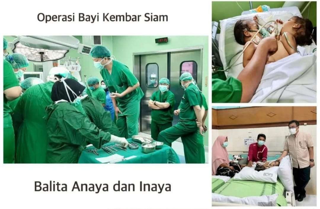 Proses operasi pemisahan balita kembar siam asal Lombok NTT di RSUD Dr Soetomo. (Foto: Istimewa)