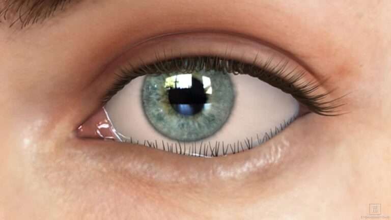 Kondisi gangguan entropion, ketika bulu mata masuk ke dalam hingga menyentuh kornea mata. (Foto: Istimewa)