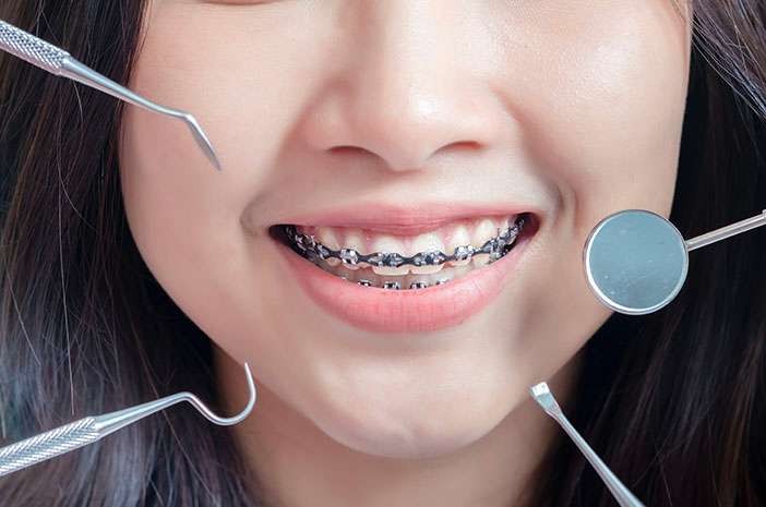 Ilustrasi memasang kawat gigi bisa memicu kondisi gusi bengkak. (Foto: Istimewa)
