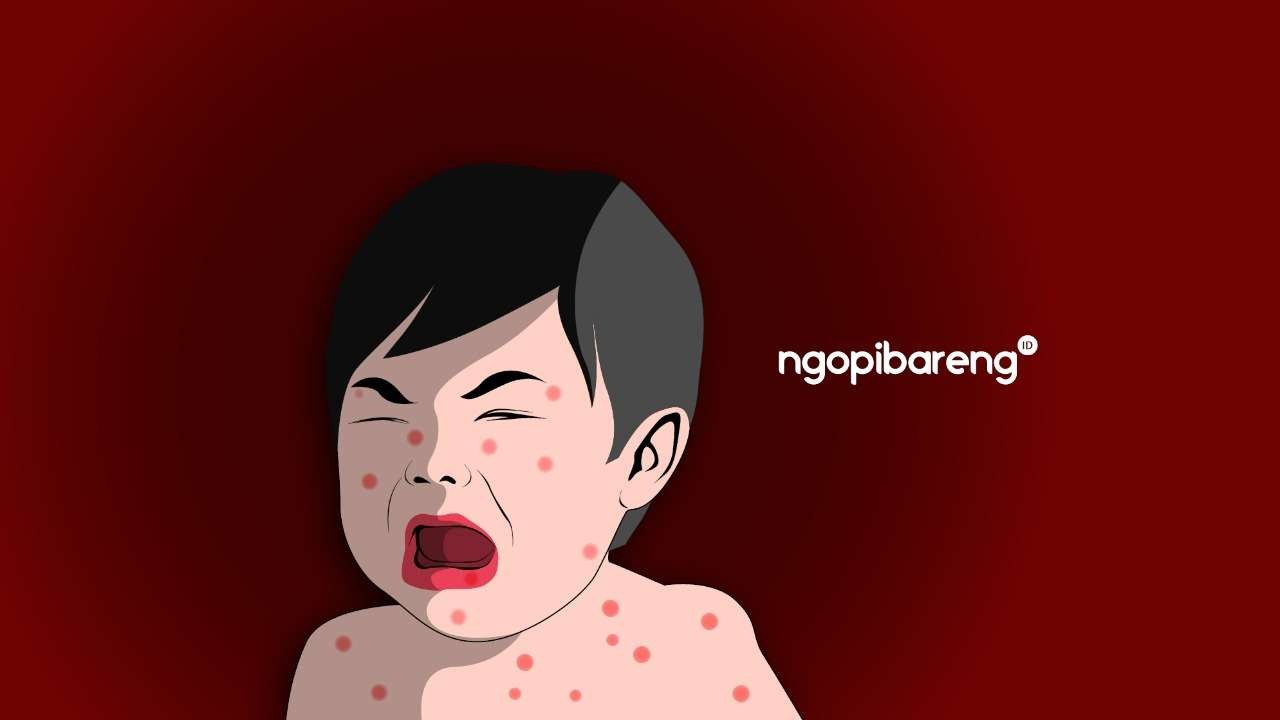 Ilustrasi flu Singapura menginfeksi anak-anak. (Grafis: Fa Vidhi/Ngopibareng.id)