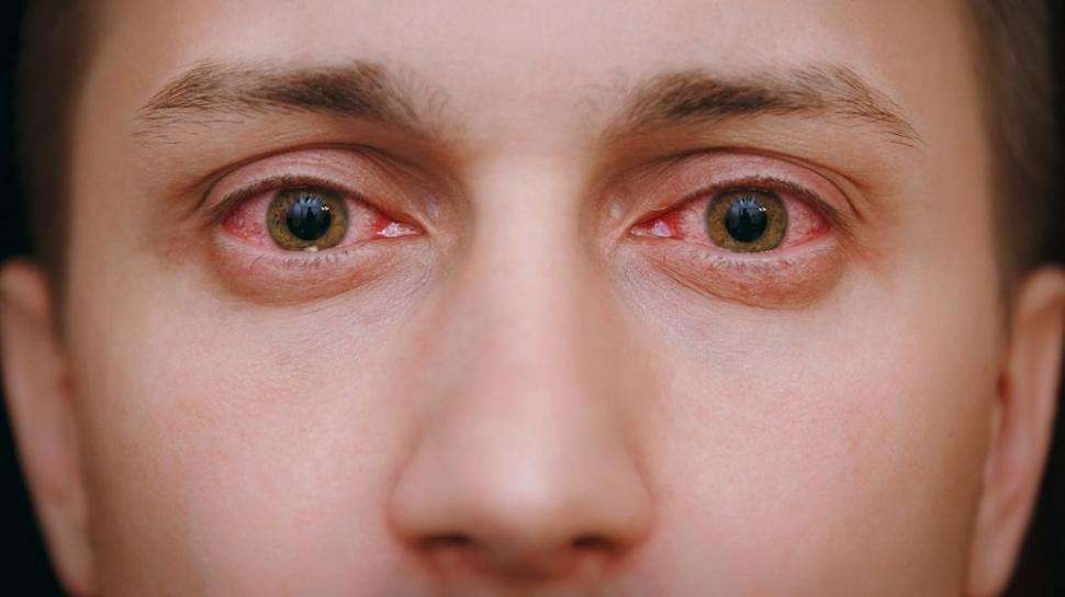 Ilustrasi mata merah (Foto: google)
