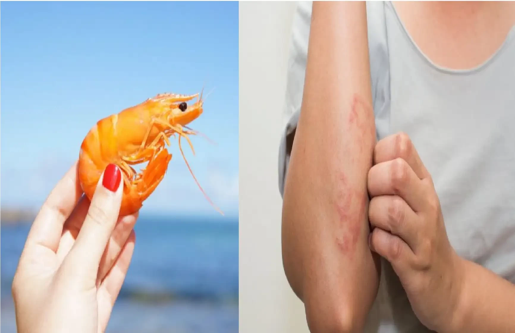 Ilustrasi pecinta seafood tak perlu khawatir alergi udang, kepiting dll. Alergi bisa diatasi dengan berbagai cara. (Foto: Istimewa)