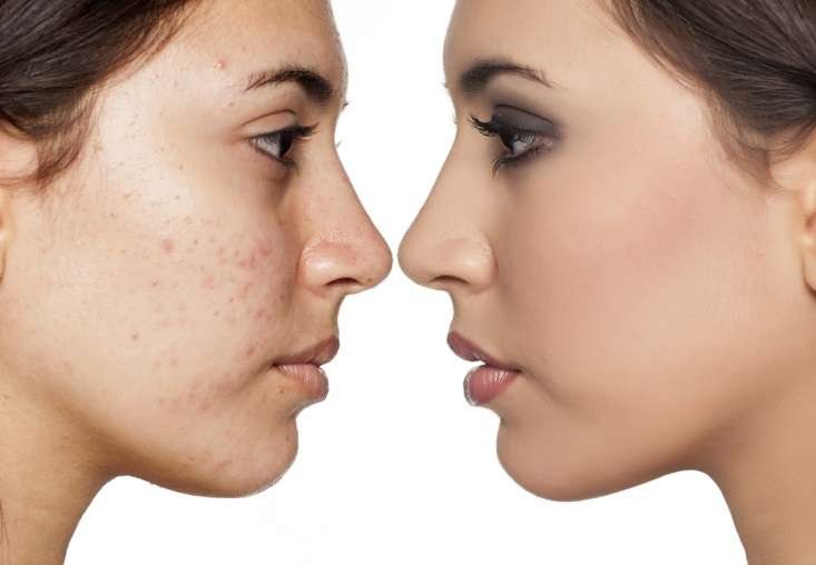 Ilustrasi kandungan niacinamide yang memiliki manfaat untuk menghilangkan jerawat di wajah. (Foto: Istimewa)