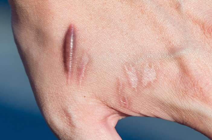 Ilustrasi penyebab dan cara menghilangkan keloid akibat bekas luka yang tak kunjung hilang di kulit tubuh. (Foto: Istimewa)