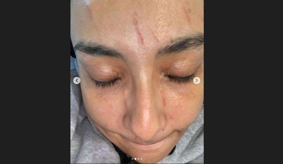 Lufya Omar memperlihatkan wajahnya yang penuh luka usai melawan penculik anak perempuannya di taman bermain di Malaysia. (Foto: Instagram @lufyalaana)