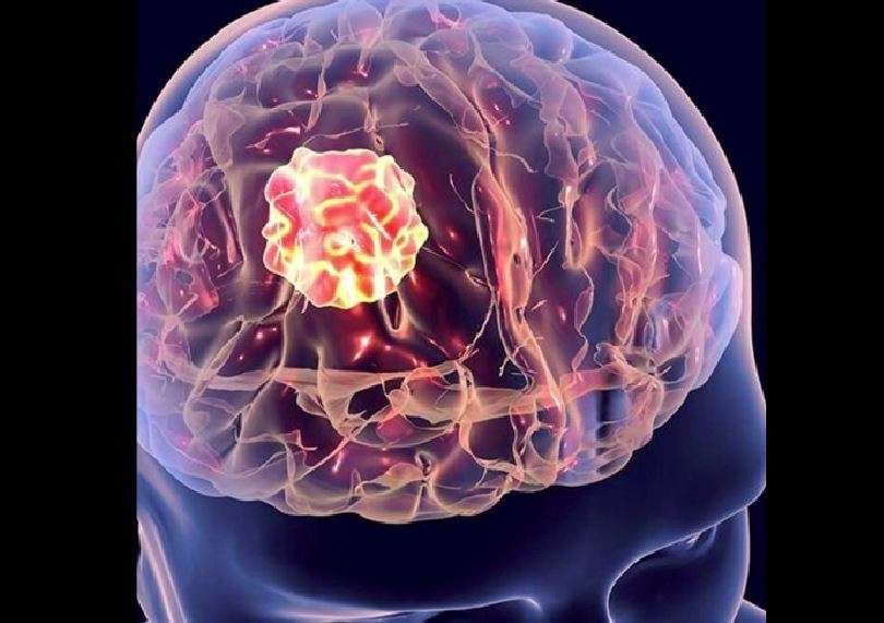 Ilustrasi metastase tumor otak yang disebabkan sebaran sel kanker. (Ilustrasi: brainly)