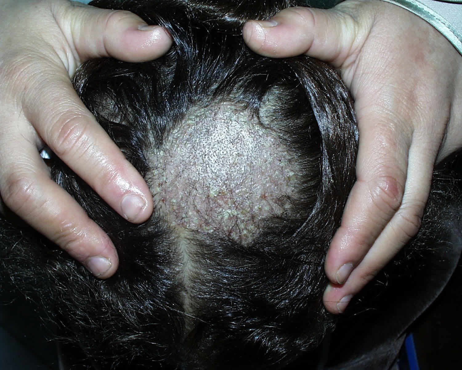 Ilustrasi penyakit tinea capitis menjangkit rambut anak-anak. (Foto: Istimewa)