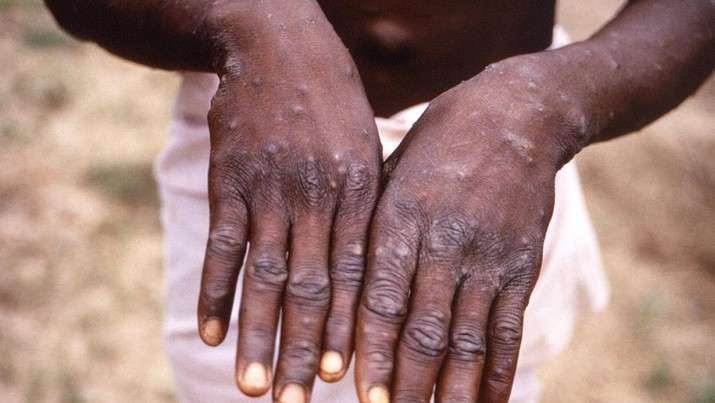 Seseorang telah terinfeksi cacar monyet atau monkeypox di Republik Demokratik Kongo (DRC). (Foto: Reuters)