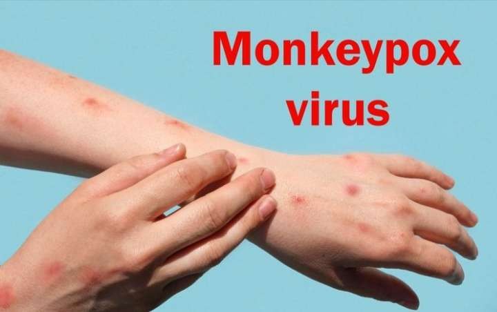 Ilustrasi, cacar monyet beda tipis dengan infeksi kulit biasa. (Foto: Istimewa)
