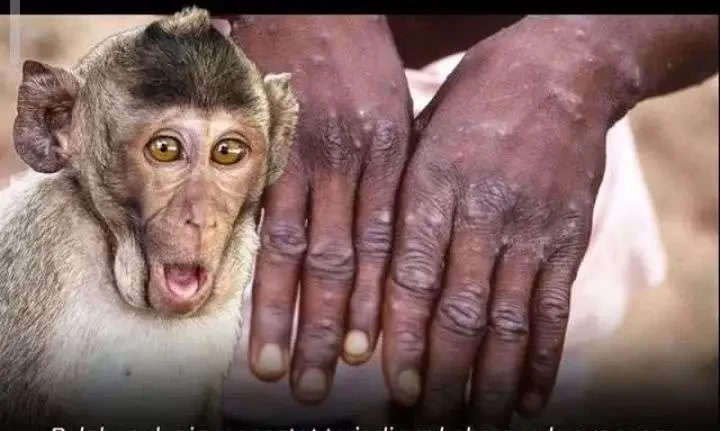 Ilustrasi kasus cacar monyet , yang kini mulai dikhawatirkan di Indonesia.(Foto: istimewa)
