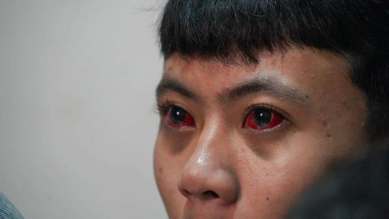 Mata merah yang dialami sejumlah korban tragedi Kanjuruhan disebabkan iritasi paparan gas air mata. Hal itu disampaikan dokter RSSA Malang. (Foto: Dok TGIPF)