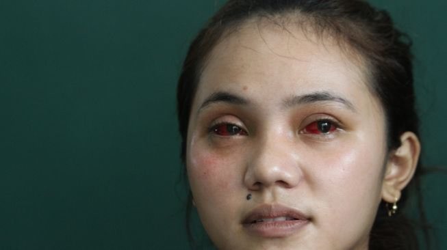 Salah satu korban tragedi Kanjuruhan yang mengalami mata merah (Foto: Antara)