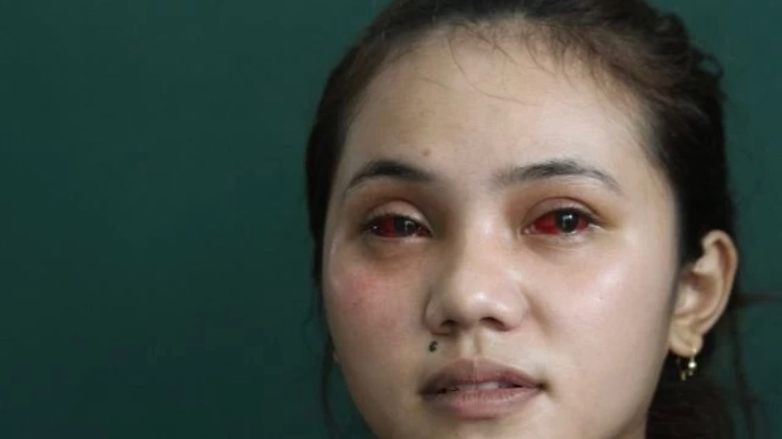 Salah satu korban tragedi Kanjuruhan yang mengalami mata merah akibat gas air mata (Foto: dok. Antara)